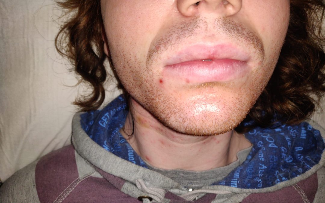 Red Beard Removal by Electrolysis