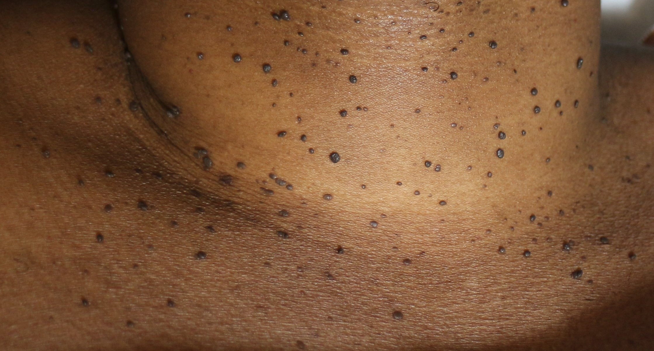 Seborrheic Keratosis