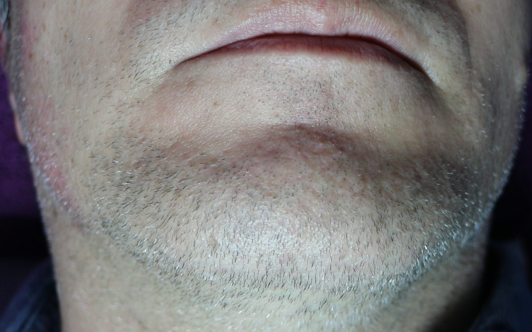 Gender-affirming – Facial Hair Removal