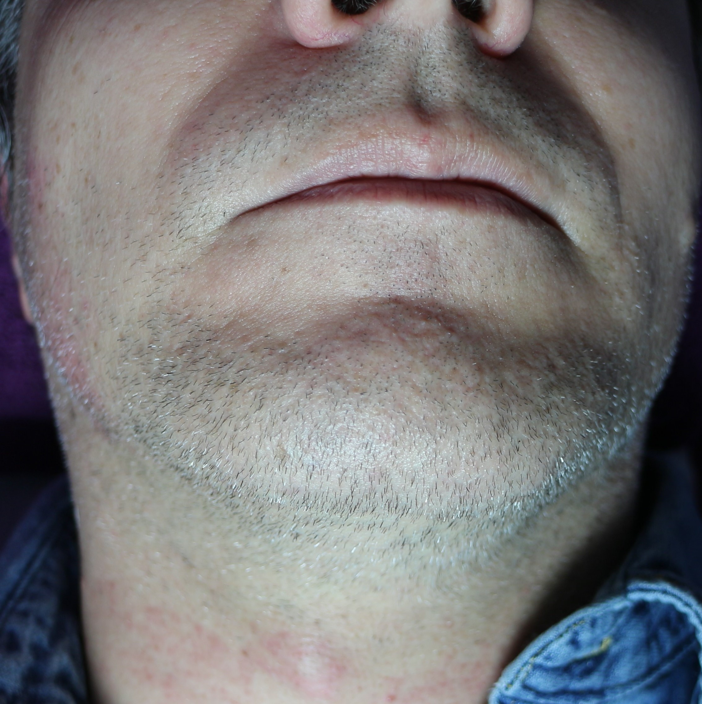 Before Beard hair removal half-face with short beard growth