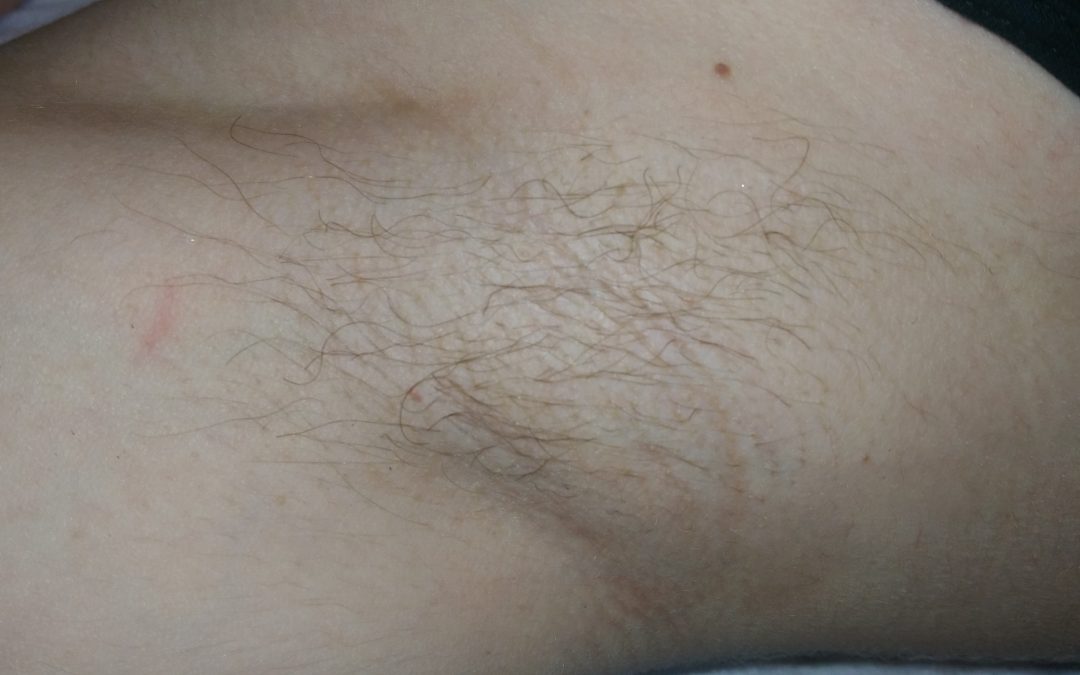 Underarm Hair Removal by Electrolysis